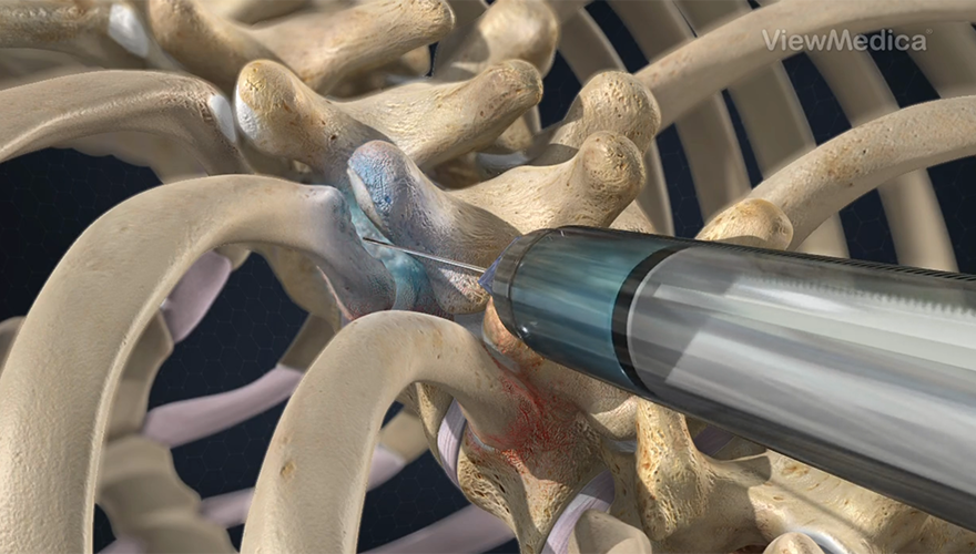 Spinal Injections for Pain Management