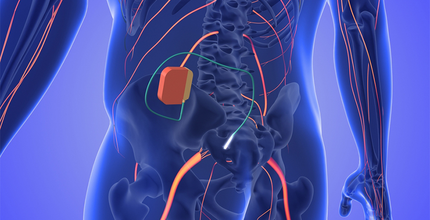 Transforming Lives: Understanding Spinal Cord Stimulation