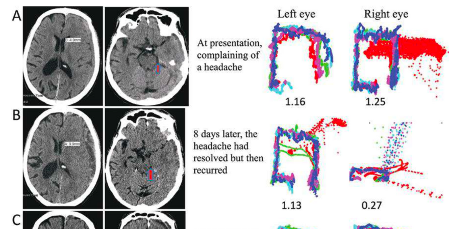 Better Concussion Care Starts Here: EyeBox Implementation in Practice