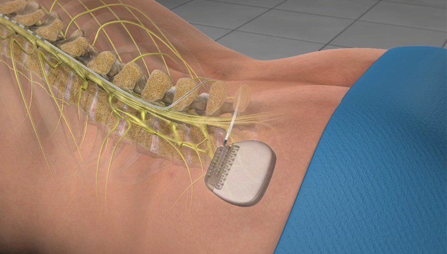 Spinal Cord Stimulator Therapy - Synergex Med Blog